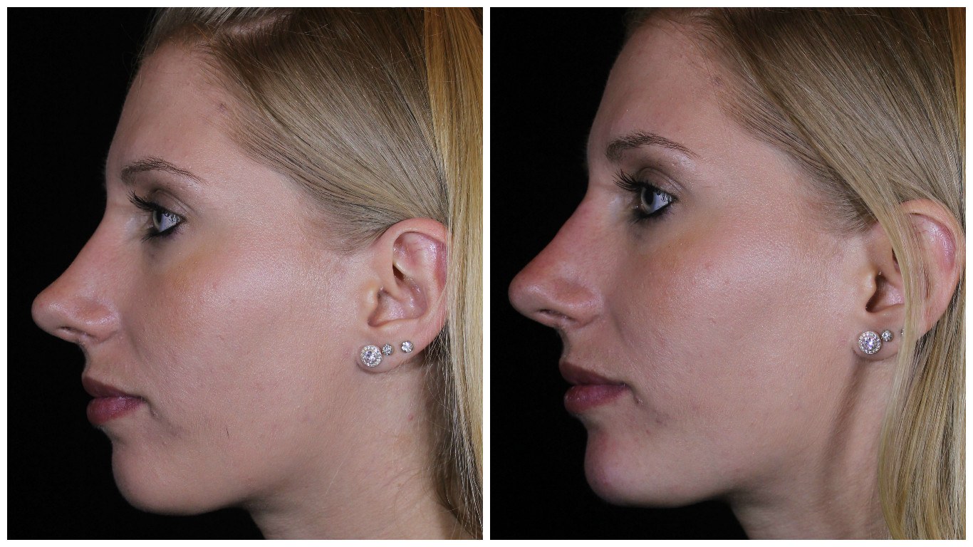 How Your Rhinoplasty Can Change as You Age: Factors That Affect Results post thumbnail image