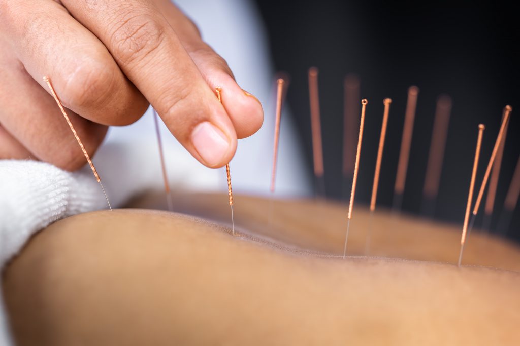 Acupuncture North York helps regulate the autonomic nervous system post thumbnail image