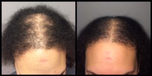The Fotona Laser: A New FDA-Cleared Device for Hair Growth post thumbnail image